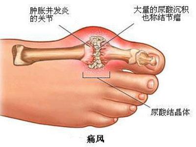 痛风发作你却一点办法也没有?看看徐学成主任怎么说 痛风发作你却一点办法也没有?看看徐学成主任怎么说