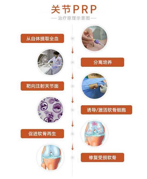 关节PRP技术 关节PRP技术治疗效果好
