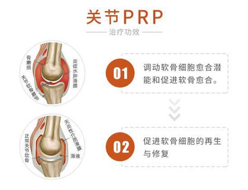 关节PRP技术治疗功效 关节PRP技术治疗效果好
