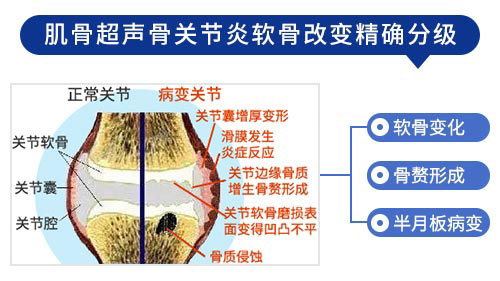 肌骨超声技术 郑州痛风风湿病医院肌骨超声技术
