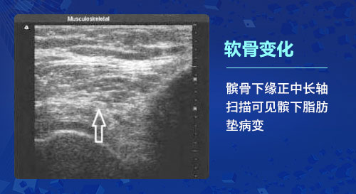 新一代MSUS肌骨超声技术 郑州痛风风湿病医院肌骨超声技术