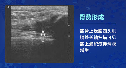 肌骨超声技术 郑州痛风风湿病医院肌骨超声技术