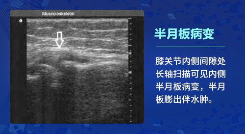肌骨超声技术 郑州痛风风湿病医院肌骨超声技术