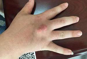 案例纪实:科学治疗痛风患者,清除痛风石 案例纪实:科学治疗痛风患者,清除痛风石