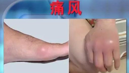 痛风性关节炎出现的主要原因徐学成专家给您分析了三个 痛风性关节炎出现的主要原因徐学成专家给您分析了三个