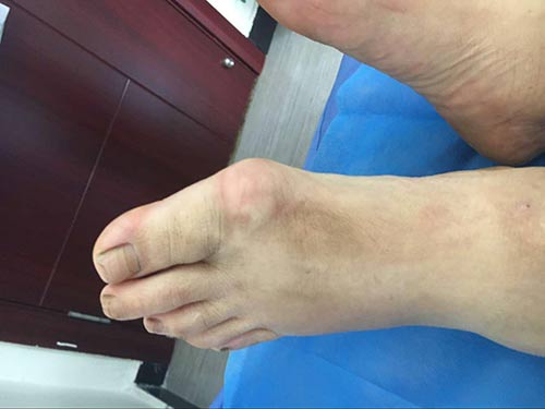 贪酒无度致痛风石在我院治疗后 贪酒无度致痛风石在我院治疗后