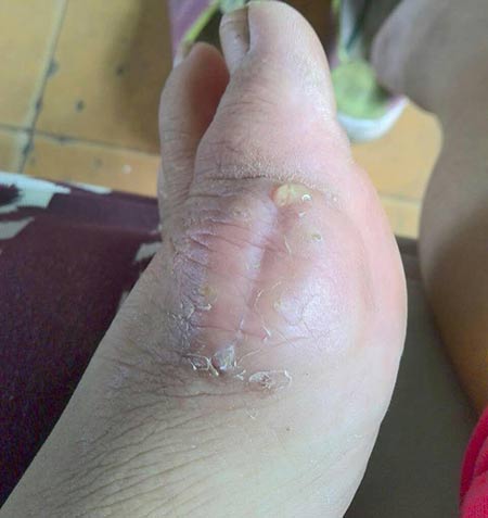 贪酒无度致痛风石在我院治疗后 贪酒无度致痛风石在我院治疗后