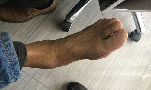 复查结果,患者双脚恢复良好 复查结果,患者双脚恢复良好