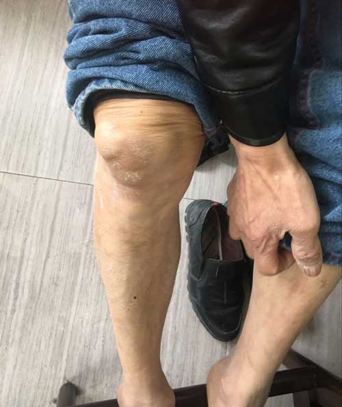 患者右膝关节有大小不等痛风石形成 患者右膝关节有大小不等痛风石形成