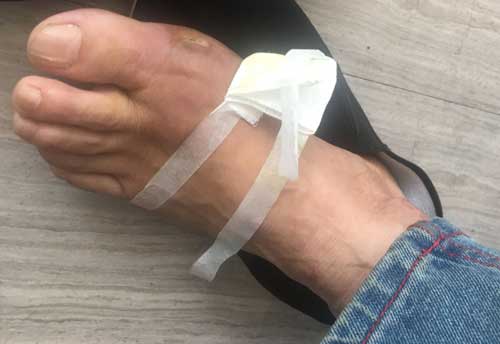 患者跖趾关节处痛风石被取出,恢复情况良好 患者跖趾关节处痛风石被取出,恢复情况良好