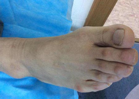 吃火锅引发痛风来我院治疗如今已 吃火锅引发痛风来我院治疗如今已