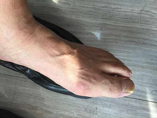痛风患者病情反复发作无法根治,求助徐学成主任 痛风患者病情反复发作无法根治,求助徐学成主任