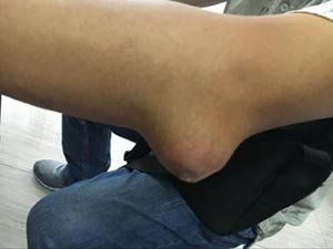 双手肘关节鸭蛋大小痛风石、双肘伸直受限 双手肘关节鸭蛋大小痛风石、双肘伸直受限
