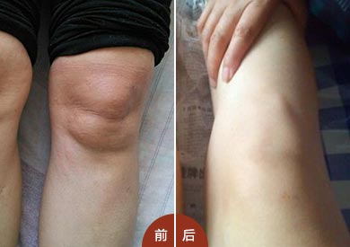 孙女士到院治疗前后对比 膝关节疼痛典型风湿性关节炎前期症状