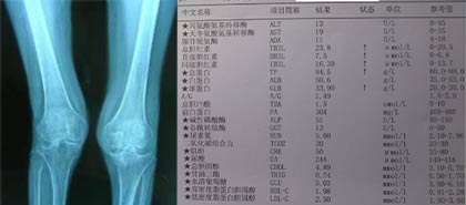 患者双膝X线检查显示关节肿大及检查化验单 膝关节疼痛典型风湿性关节炎前期症状