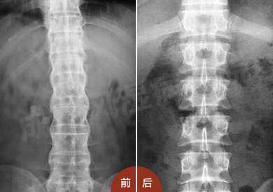 找对治疗方案治疗强直性脊柱炎疾病是关键 找对治疗方案治疗强直性脊柱炎疾病是关键